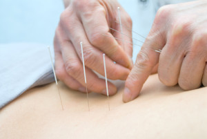 Acupuncture