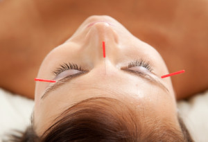 acupuncture treatment