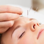 acupuncture